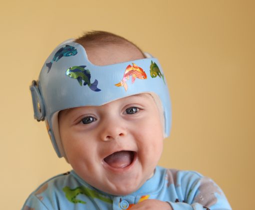 Infant wearing a helmet or band for treatment of plagiocephaly (Shallow depth of field. Focus on child's eyes.)SEE ALSO: